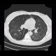 Fungal infection of lung, mycosis: CT - Computed tomography
